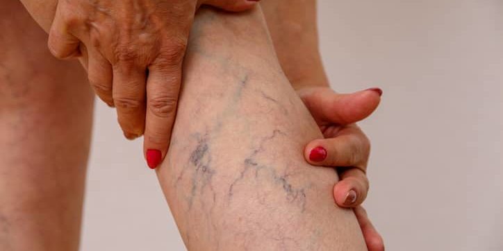 varicose veins