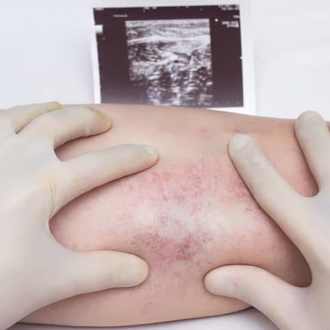 Venous Insufficiency A doctor in gloves examines the veins