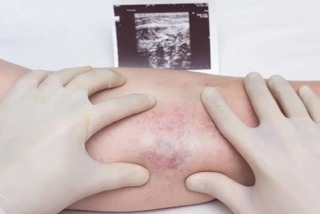 Venous Insufficiency A doctor in gloves examines the veins