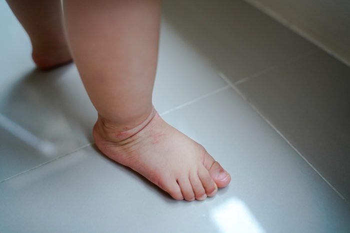 Swollen legs