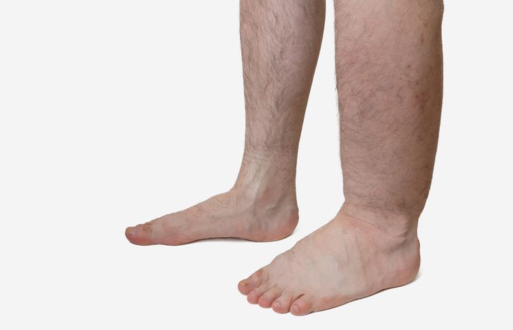 Swollen leg