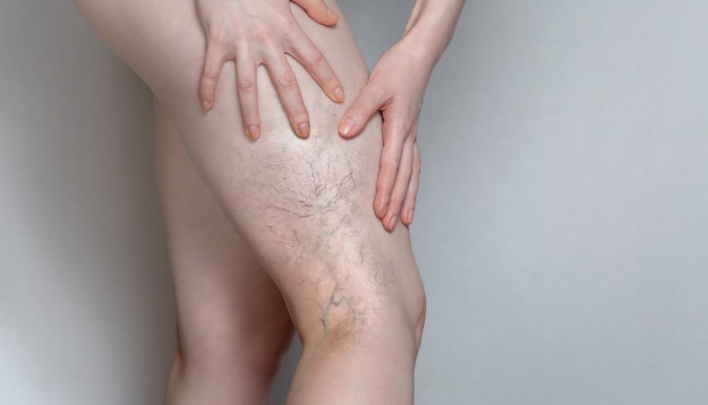 picture of spider veins on a persons leg
