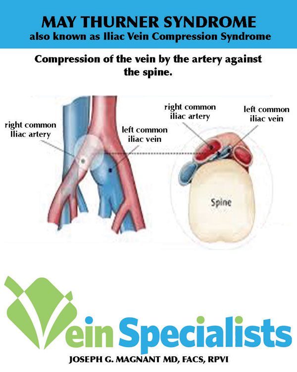 Pelvic Congestion Syndrome Treatment