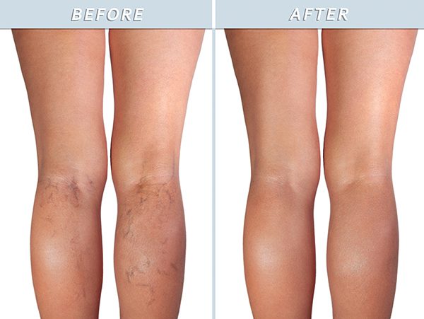 Before and After Vein Treatment