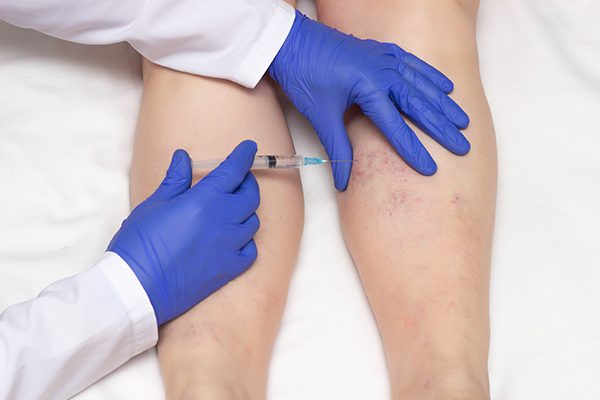 Sclerotherapy Procedure Calf Muscles