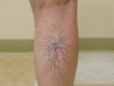 spider veins below knee