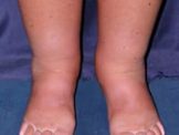 ankle swelling