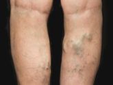 varicose veins