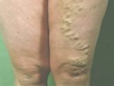 varicose veins