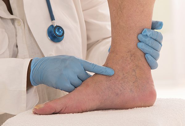 Vein Doctor pointing out foot veins