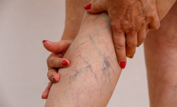 Varicose veins on leg