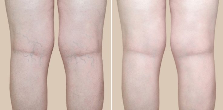 The spider vein treatments from Vein Specialists will give you back your beautiful, healthy legs.