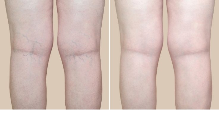 before-after Before & After Spider Vein Treatment
