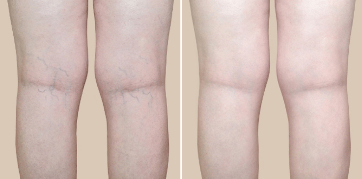 The spider vein treatments from Vein Specialists will give you back your beautiful, healthy legs.
