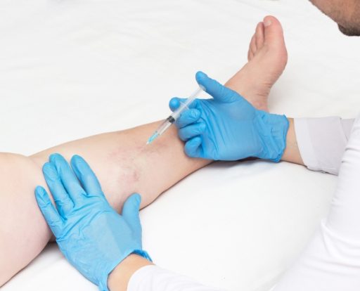 The benefits of sclerotherapy to treat spider veins include minimal discomfort and a short healing process.
