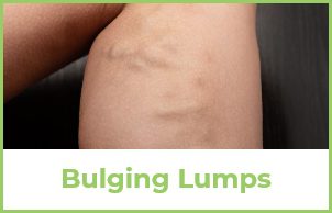 Bulging Lumps Example