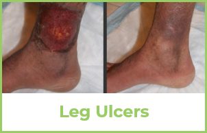 Leg Ulcers Example