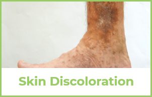 Skin Discoloration Example