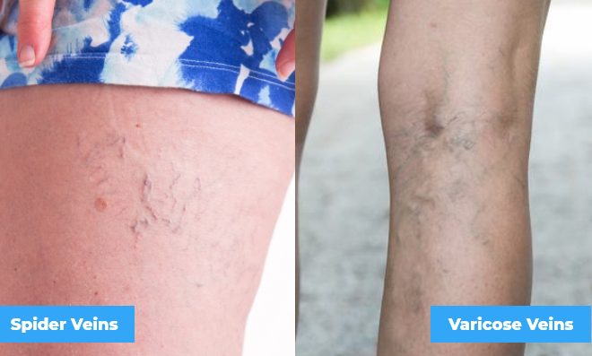 Spider Veins and Varicose Veins Side by Side Example