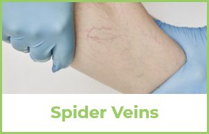 Spider Veins Example