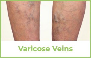 Varicose Veins Example