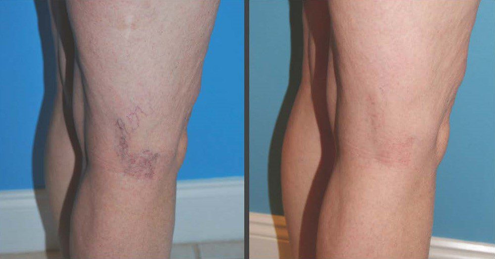 Before and After Image of Spider Vein Treatment