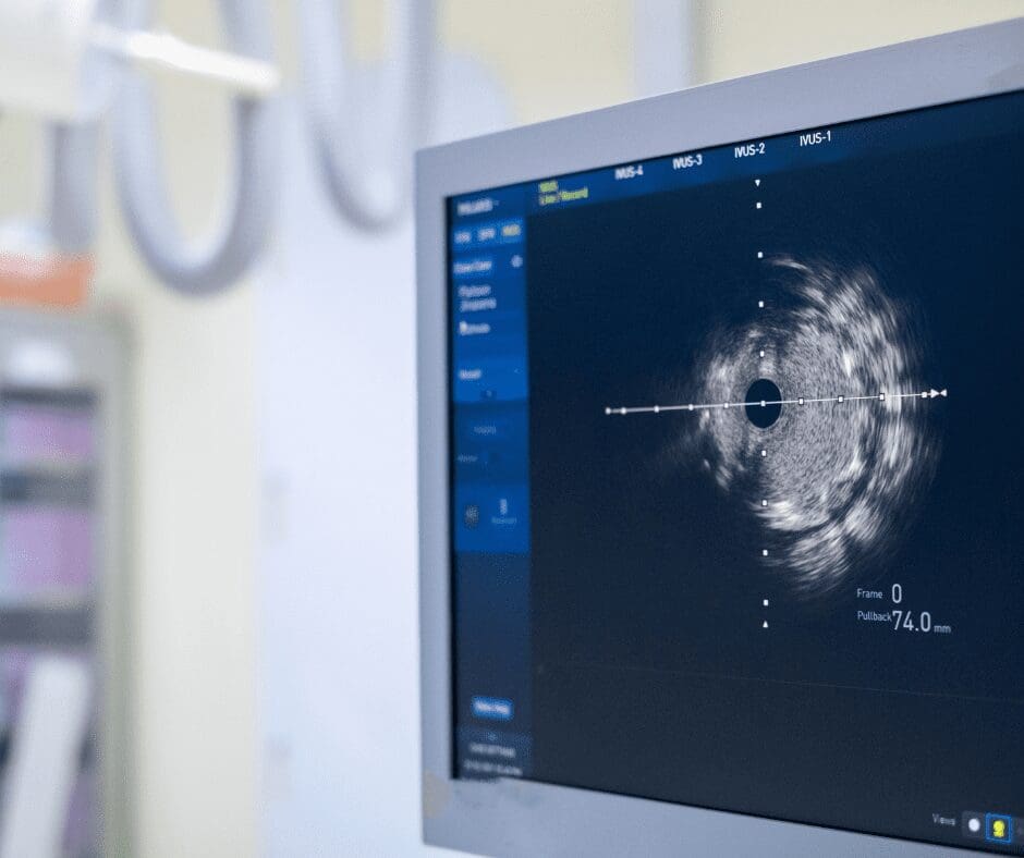 IVUS Procedure