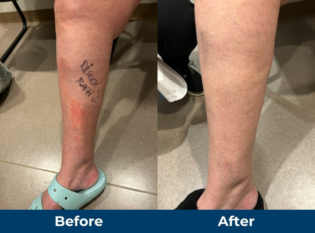 Before and After Endovenous Ablation for Disney Rash